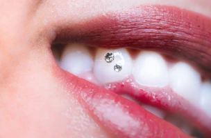 Zdjęcie biżuterii nazębnej, kolczyków tooth gems.